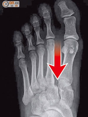 廿七歲女病人跌傷後，左腳腳面近腳趾公位置（箭咀示）的蹠骨骨折。