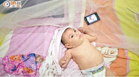 巴西有孕婦感染寨卡病毒後，誕下患有小頭畸形症的嬰兒。