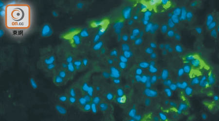人類腎臟足細胞被新沙士病毒感染。
