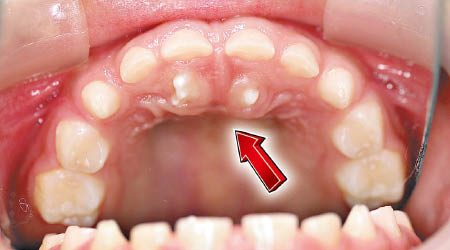 多生齒一般長在上顎門牙後方（箭嘴示）。（受訪者提供）