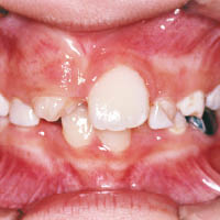部分多齒症患者的牙齒排列不整，影響外觀。（受訪者提供）