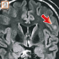 磁力共振圖片顯示，C先生左腦（箭嘴位）有一粒似「小豆」般陰影，術後切出直徑一厘米的腫瘤。