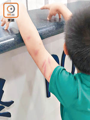 男童的手臂有明顯傷痕。（文健雄攝）