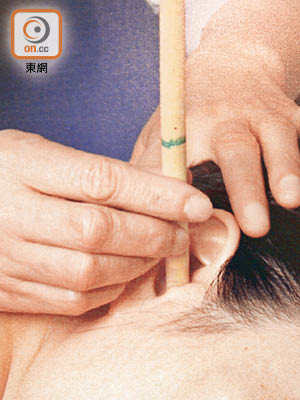 耳燭療法聲稱可吸出耳垢，但慎防引致燒傷。（資料圖片）