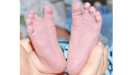 嬰兒攝取過多亞硝酸鹽，可致藍嬰綜合症，皮膚呈紫藍色。（互聯網圖片）