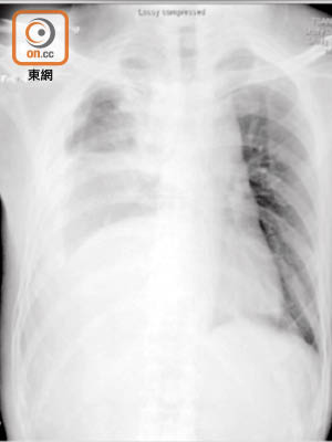 肺癌病人X光片顯示右肺有積水，但醫護人員誤在他左胸抽肺水致出現氣胸。（醫管局提供）