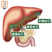 患者的結石可積滿膽囊、膽管及肝臟。（設計圖片）
