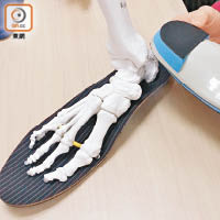 患者可訂造矯型鞋墊防止寬扁惡化。