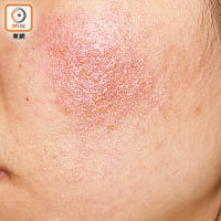 使用劣質面膜，有機會引致皮膚過敏。