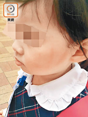 藍田圓玄幼稚園有三歲女童面部受傷。