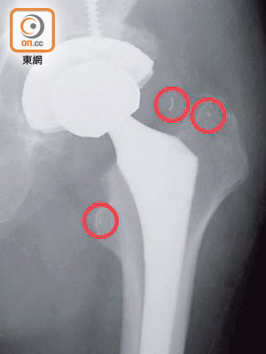 病人術後做X光檢查，證實遺留三粒線圈（紅圈示）於體內。
