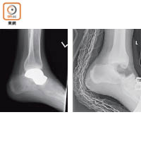 病人左腳失去距骨（右圖）。植入金屬距骨假體，與上方腓骨及下方腳跟骨磨合（左圖）。