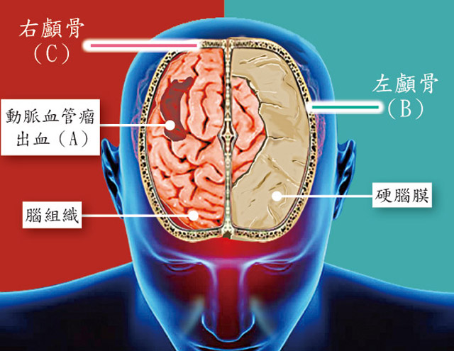 左右不分開錯腦 伊院離譜 病人捱刀