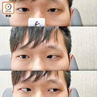 三十多歲男病人右眼神經線發炎，當雙眼向前（上圖）及向左（下圖）望時，外觀無異常，但當向右望（中圖），才發現右眼內斜視。（受訪者提供）