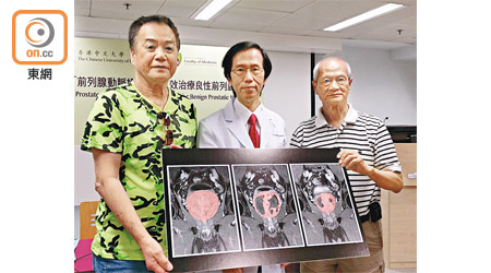 余俊豪（中）指前列腺動脈栓塞術可改善患者排尿問題，且不影響性功能。左為徐先生，右是另一名患者周伯。（鍾君容攝）