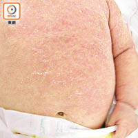 濕疹發作令皮膚長滿紅疹，痕癢無比。