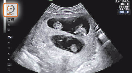 懷多胞胎風險高，半數孕婦選擇減胎。（資料圖片）