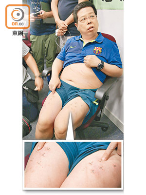 林子健公開展示被迷暈禁錮毒打的傷勢，包括大腿上的廿多口釘書釘。（溫國佳攝）