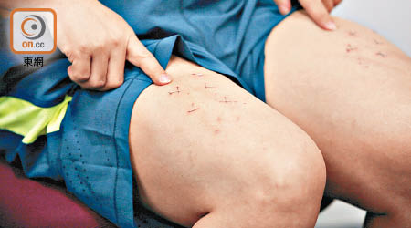 林子健在八月十一日記者會上展示「大腿書釘」。（資料圖片）