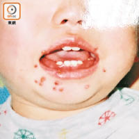 幼兒用手觸摸患者唾液再放入口，容易患齦口炎，嘴巴附近亦會起水泡。（受訪者提供）