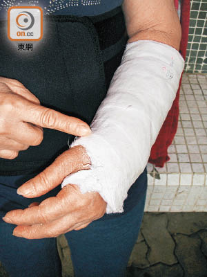 手腕骨折是脆性骨折的第一個警號。