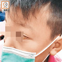 男童昨晚在私家醫院接受從耳內取出異物手術。