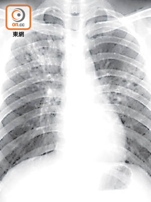 照X光可檢驗肺癆。（資料圖片）