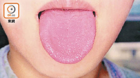 猩紅熱患者的舌頭或出現草莓樣的紅色凹凸外觀。（資料圖片）
