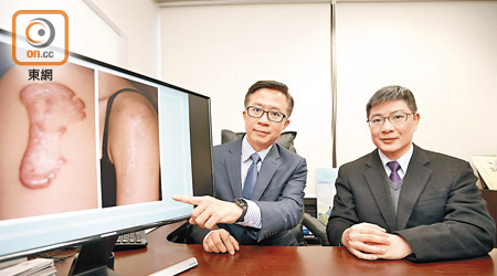 陳東飛（左）及陳亮祖（右）解釋，每一百個人便有三人有遺傳性瘢痕瘤體質。（袁志豪攝）