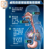 威院食道球插錯氣管圖解