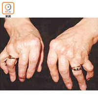 類風濕關節炎患者關節可變形扭曲，晚期病人手指畸形。