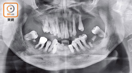 女病人確診末期牙周病，求醫時全部牙齒搖搖欲墜。