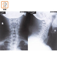 黃伯一六年檢查時，五節頸椎嚴重變形或生骨刺。（受訪者提供）