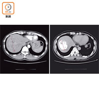 肝癌病人腫瘤直徑約十厘米（左圖），用「消融化療栓塞術」治療後縮至六厘米（右圖）。（中大提供）