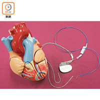 心臟核纖層蛋白病患者，需要在體內安裝起搏器或除顫器。