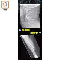 兩X光圖顯示，跳彈床導致頸椎受傷及腿骨折斷。（受訪者提供）