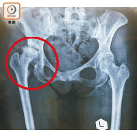 從謝小姐去年換關節前的X光片可見，右邊股骨磨成半球狀（紅圈示），並向上侵蝕盆骨。（受訪者提供）