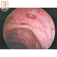 患者腸壁有多個直徑數毫米大的囊狀物。（網上圖片）