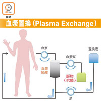 血漿置換技術參考圖