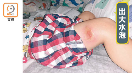 郭偉強的兩歲大兒子被蚊咬後，傷口皮膚紅腫起水泡。（受訪者提供）
