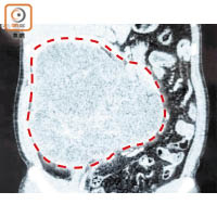 掃描顯示病人腫瘤極大（紅圈示），明顯壓到腸臟，令其兩邊腰部線條被逼得不對稱。（受訪者提供圖片）