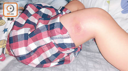 有市民被毒蚊咬後，傷口出現紅腫、水泡或含膿，需入院治療。