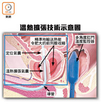 溫熱擴張技術示意圖