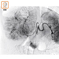 相關治療是經動脈導管引入肝再注射含釔90的微粒。（養和醫院提供）