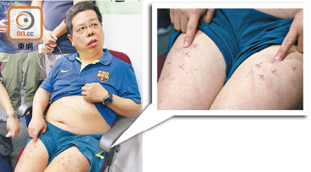林子健曾公開展示傷勢，包括大腿上各五個十字形釘傷。