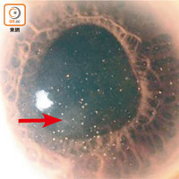 在裂隙燈檢查下，葡萄膜炎患者的虹膜會出現一點點（箭嘴示）的發炎症狀。（受訪者提供）