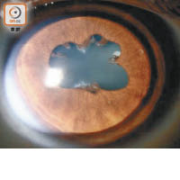 葡萄膜炎有機會導致虹膜與晶體黏連，令虹膜縮小，更有機會誘發急性青光眼。