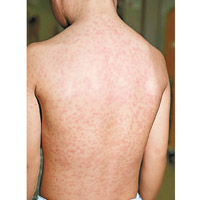 本港今年麻疹個案有升溫之勢，患者皮膚會現污斑紅疹。（資料圖片）