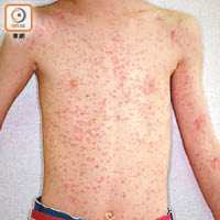 麻疹會令患者皮膚泛現紅斑。