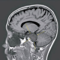 陳淑莊被發現腦部有直徑四點二厘米的腫瘤。（互聯網圖片）